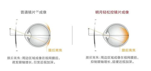 明月鏡片推出「輕松控」 專為中國孩子設計的青少年近視管理鏡片